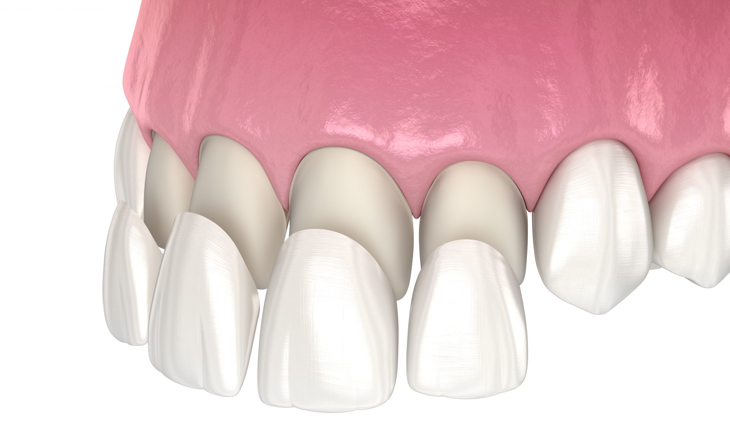 Dental Veneers | Advanced Health Dental Centre | Bankstown