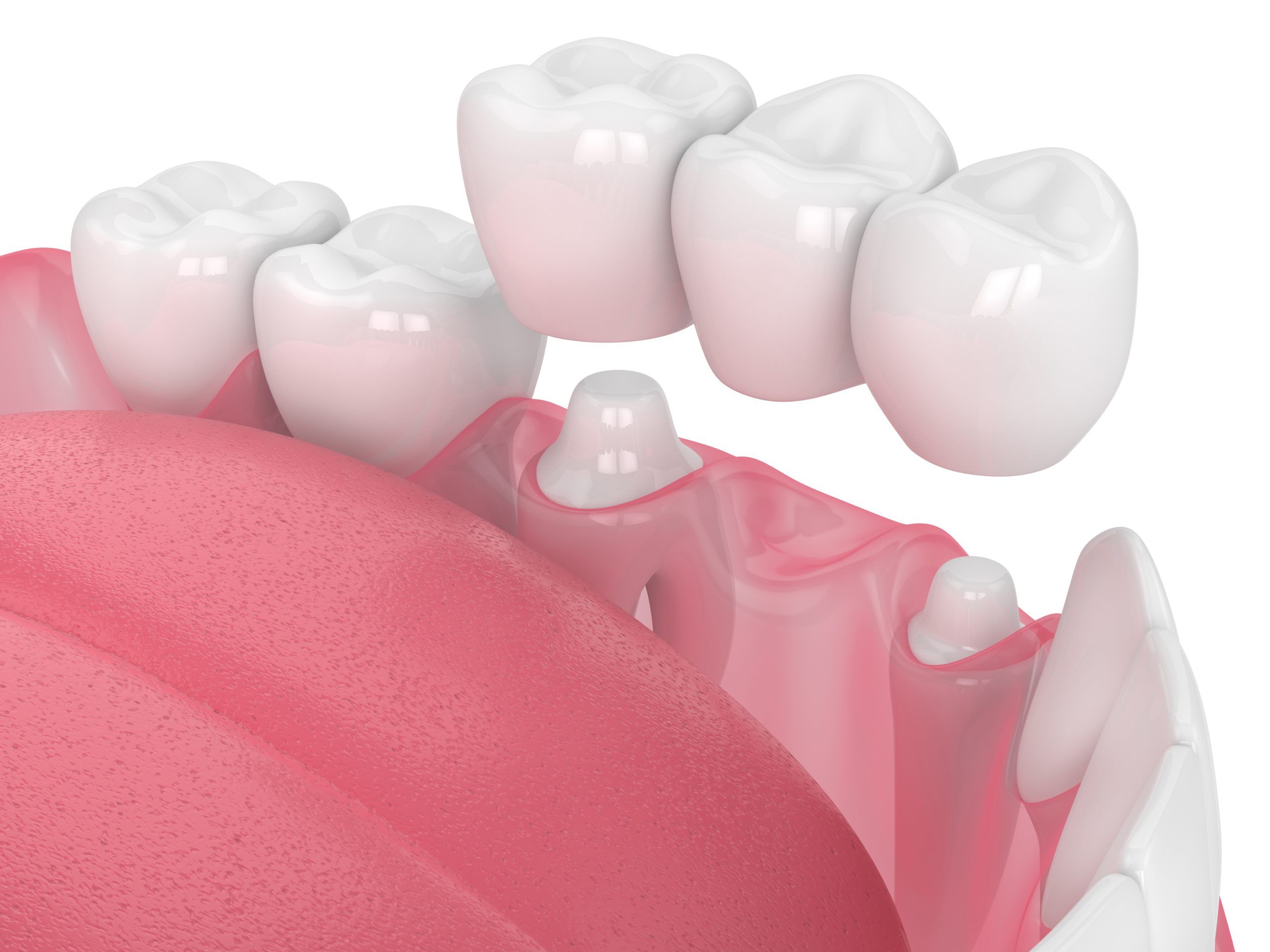 3d render of jaw with dental bridge  over white background