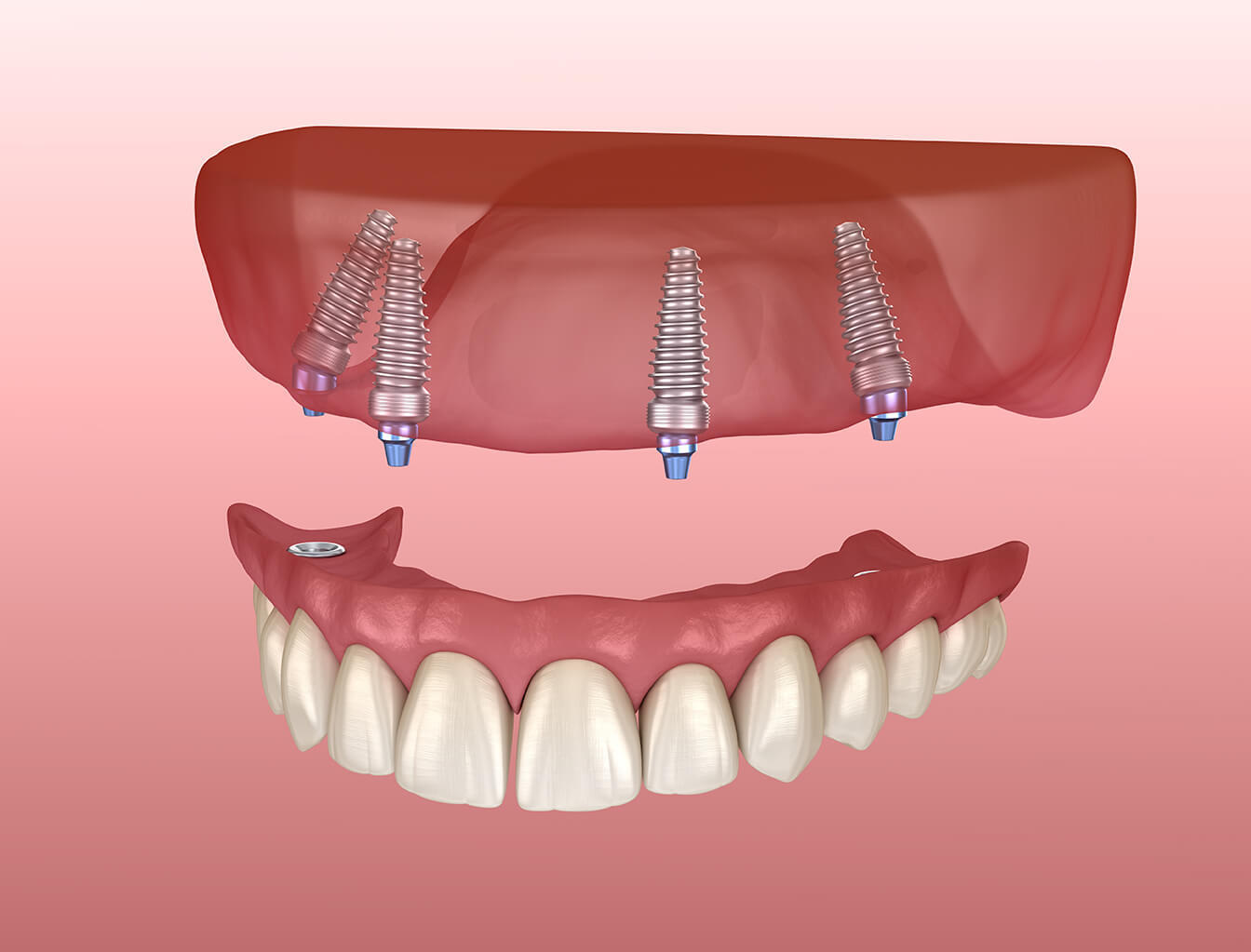 Implants | Advanced Health Dental Centre | Bankstown