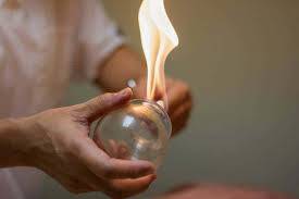 Cupping | Advanced Health Medical Centre | Bankstown