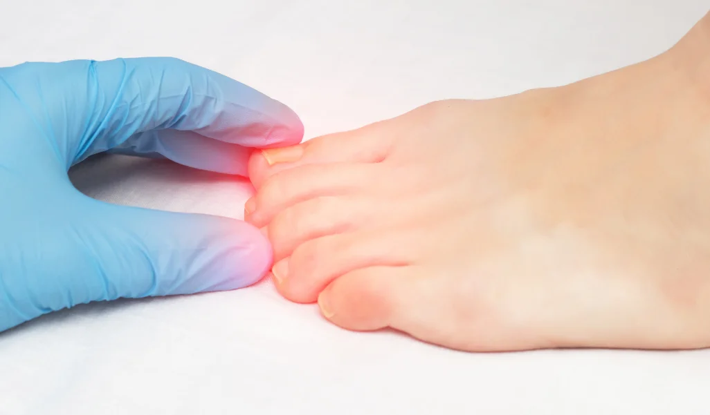 Ingrown Toenails | Advance Health Medical Centre